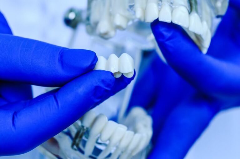 Dental Crowns and Bridges