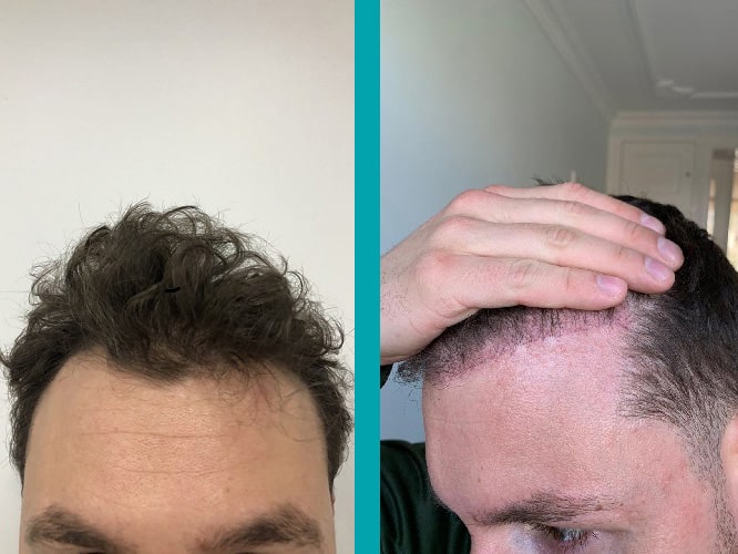 Hair Transplant 1