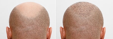 Hair Transplant Men 1