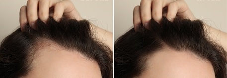 Hair Transplant Women